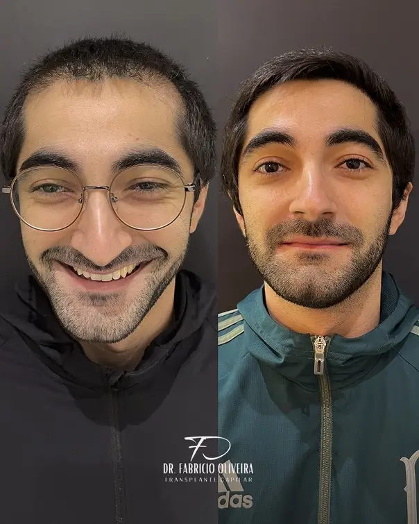 Antes e depois 01 FO