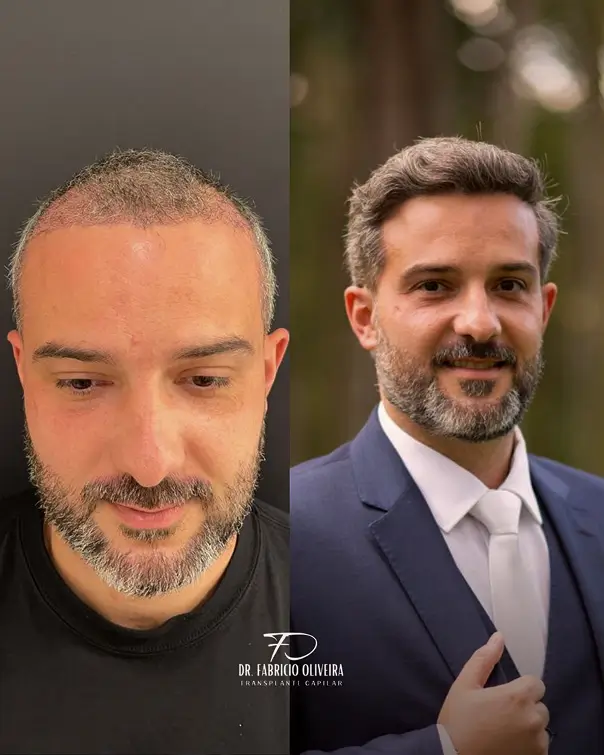 Antes e depois 02 FO