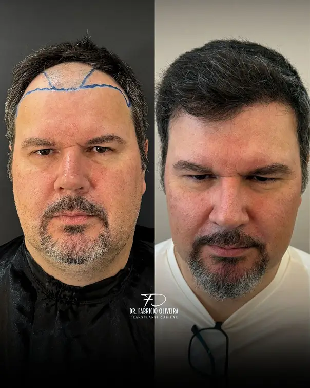 Antes e depois 03 FO