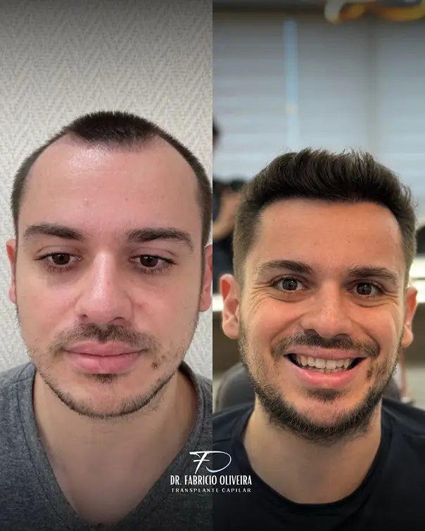 Antes e depois 04 FO