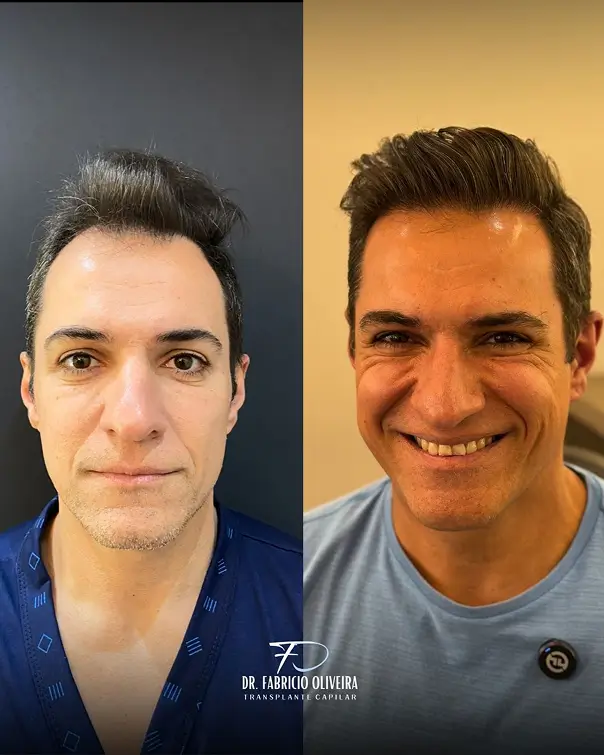 Antes-e-depois-05-FO.webp
