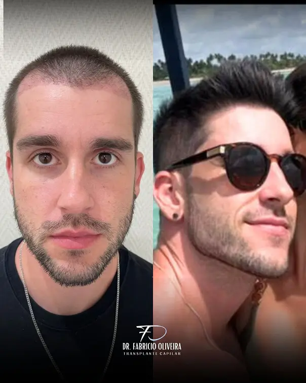 Antes e depois 06 FO