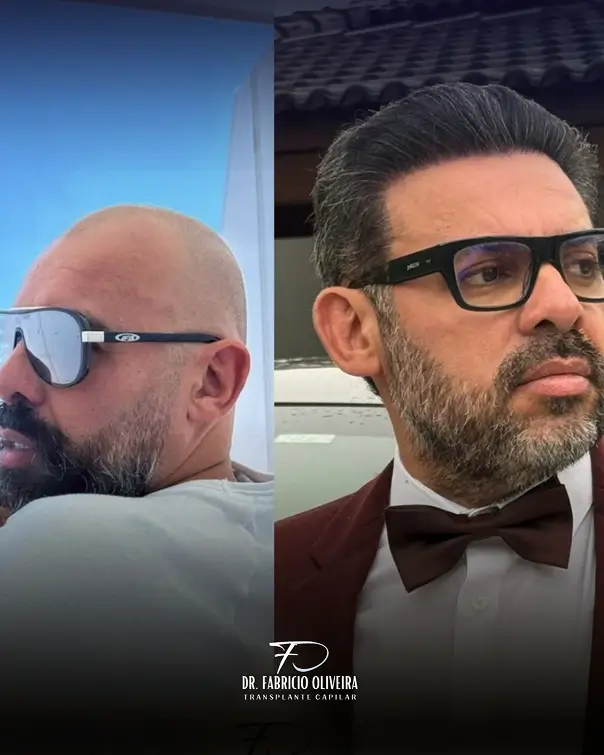 Antes e depois 07 FO